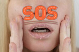 Labbra screpolate e SOS